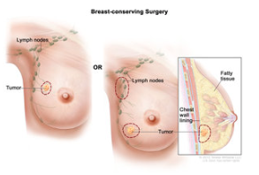 Breast Surgery